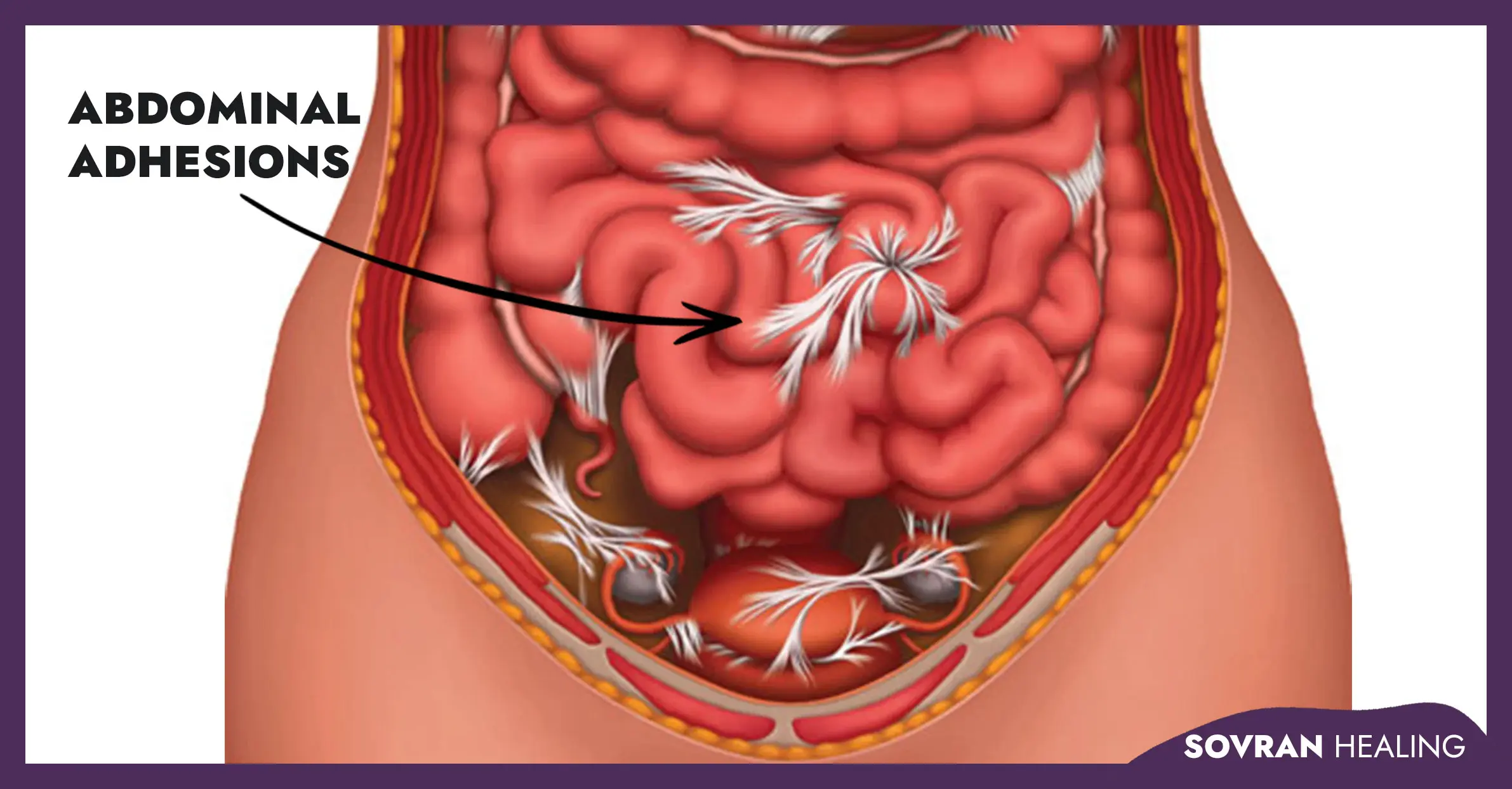 Illustration showing abdominal adhesions post Cesarean section Complications that can occur years later